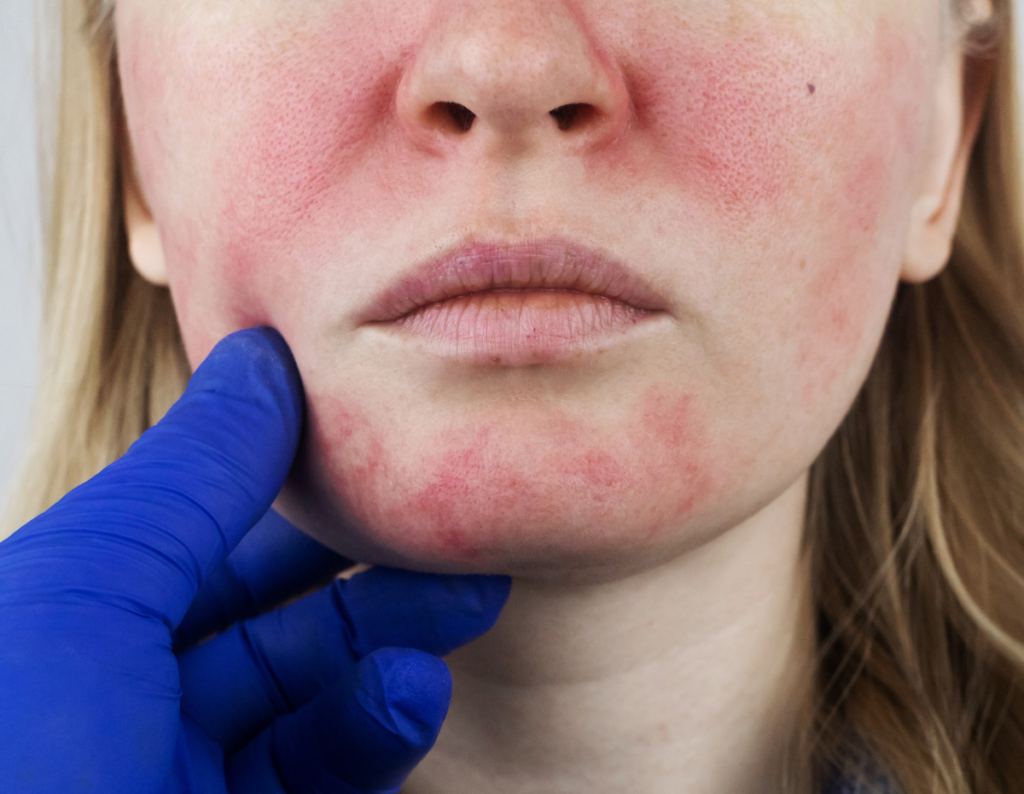 Rosacea