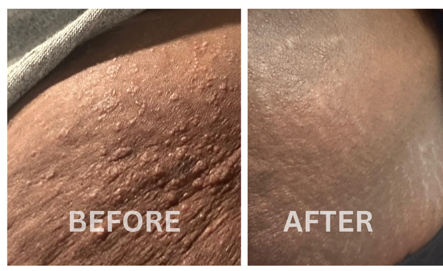 skin eczema3